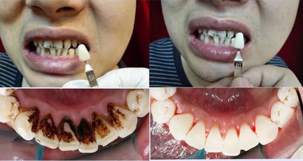 可以逐渐去除牙齿表面的菌群沉淀