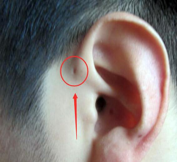 孩子生来耳朵上就有小孔是怎么回事家长要心中有数别忽视了