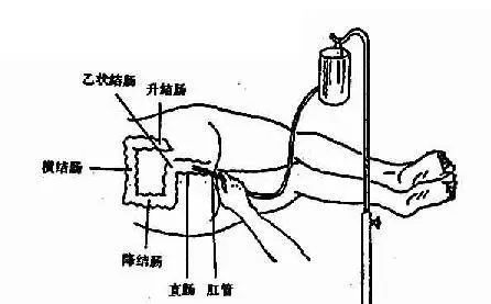 洗肠子