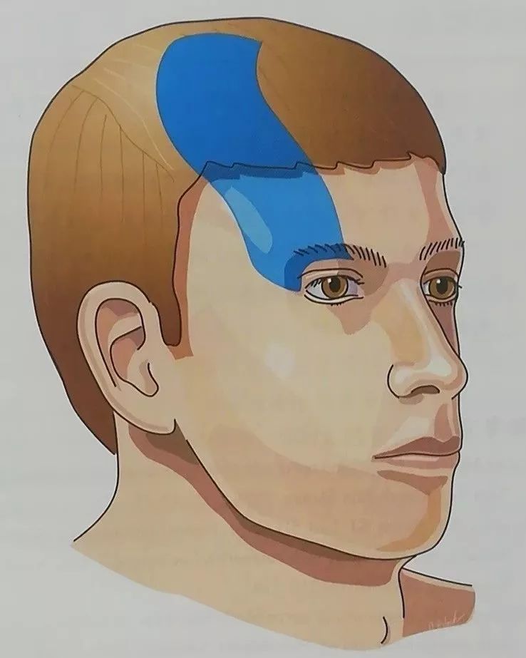 眶上神经的感觉分布区6镇痛剂过量性头痛临床综合征患者因过度服用