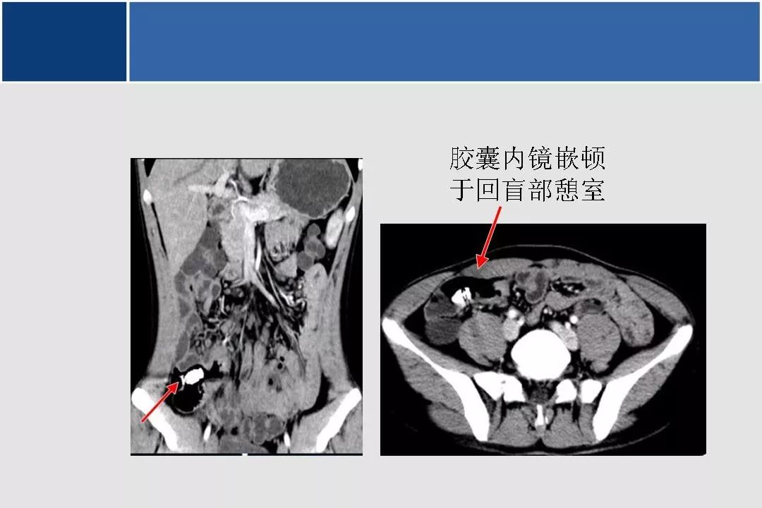 小肠ct分段解剖图图片