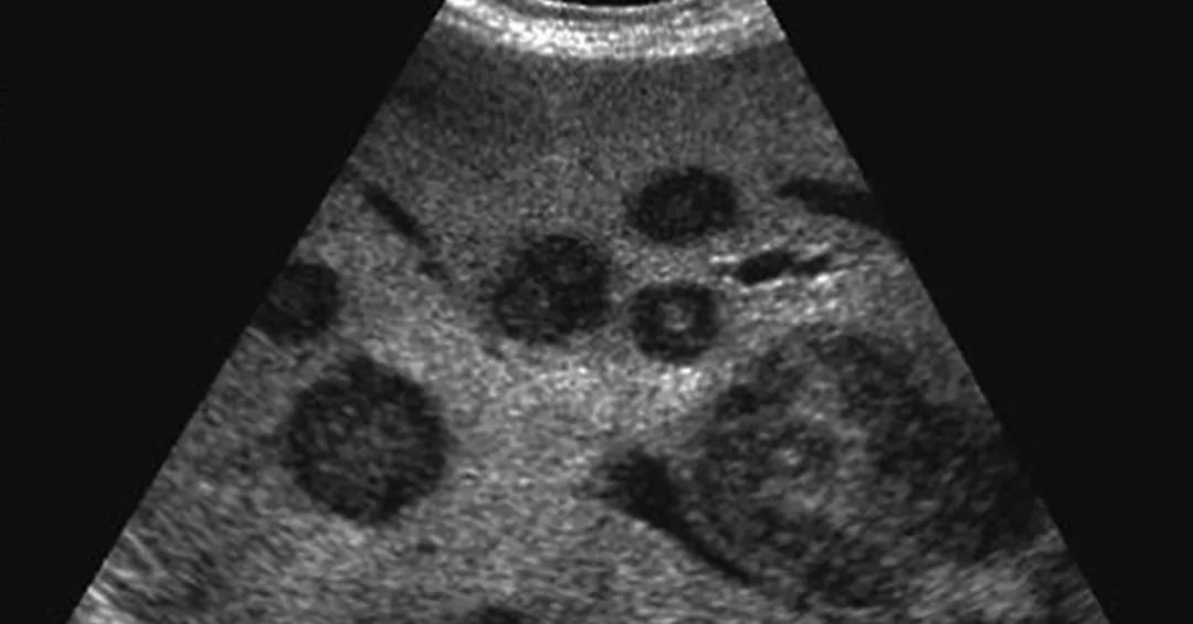 肝胆疾病常见的超声征象