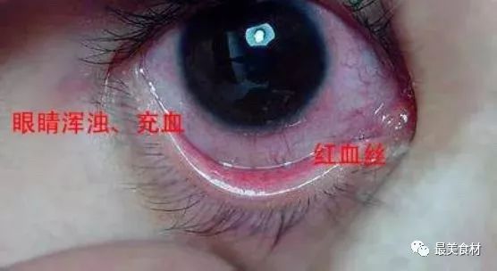 导致眼睛浑浊,充血,满眼红血丝超级可怕小妹最近就因为滴错了眼药水