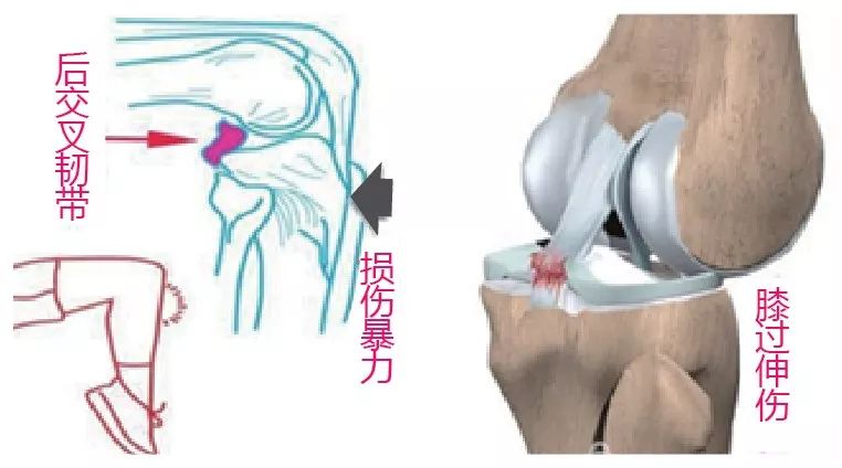 脛骨鑲嵌技術讓膝關節韌帶重獲新生