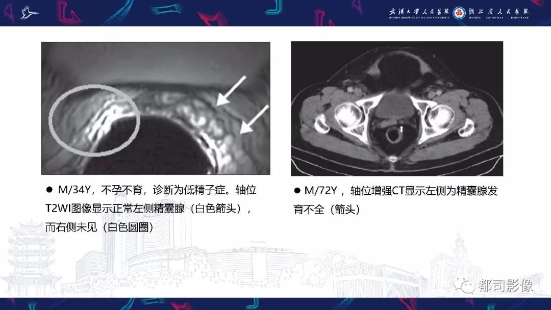 精囊腺病变mri表现