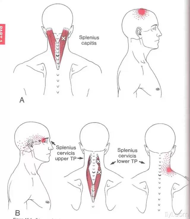肌筋膜触发点详细图谱建议收藏