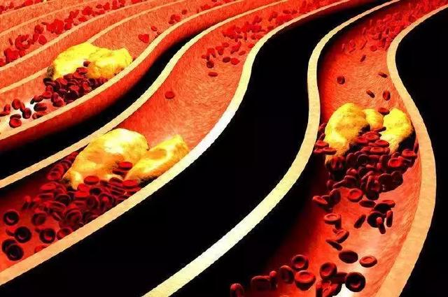 动脉粥样硬化应该注意这些划重点