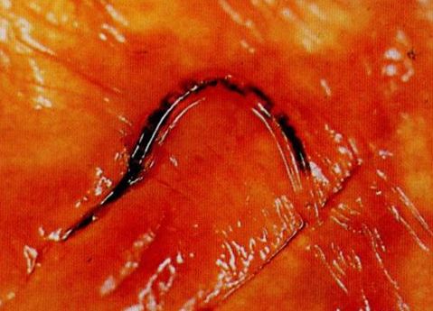 它的中绦期(幼虫)被称为囊尾蚴,囊尾蚴以充满液体的囊泡形式,寄生于猪