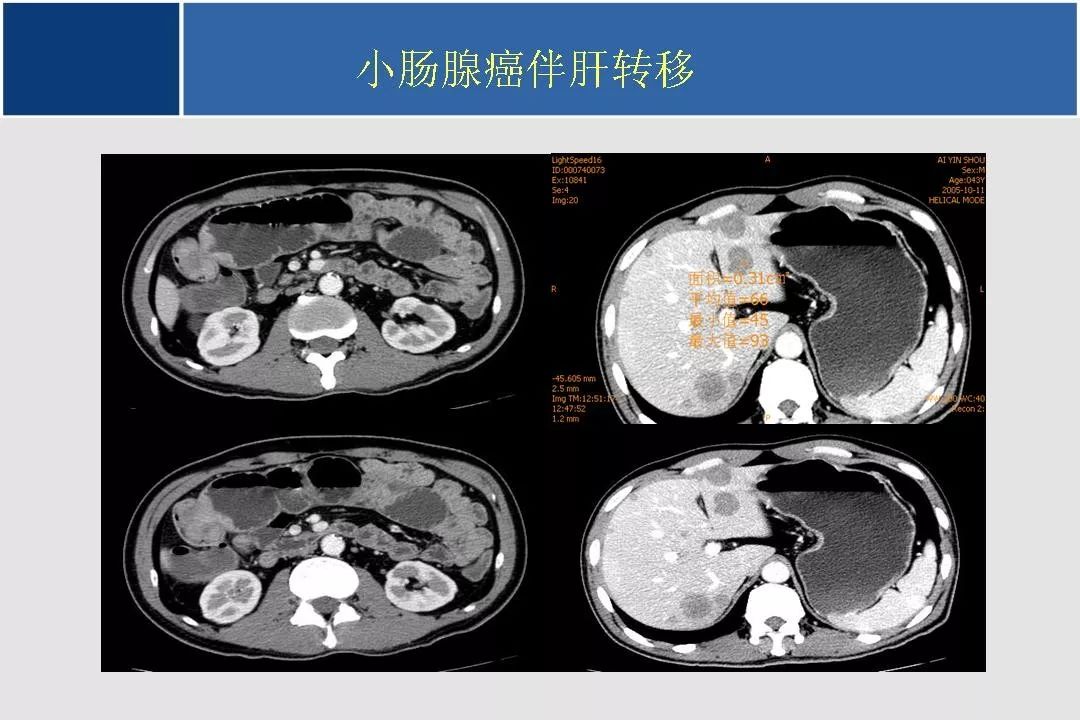 小肠的ctmr影像诊断及进展丨影像天地