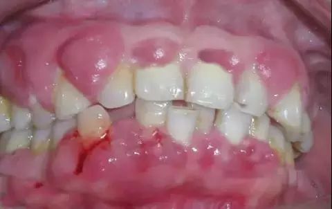 艾滋病的口腔病症和如何做好职业暴露预防牙医一定要看