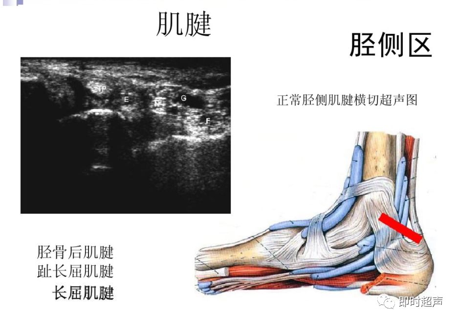 超声在足踝部检查中的应用