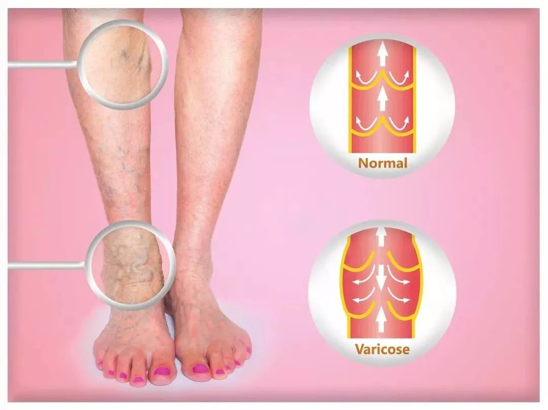 下肢静脉曲张,你也有这样的烦恼吗?_护理