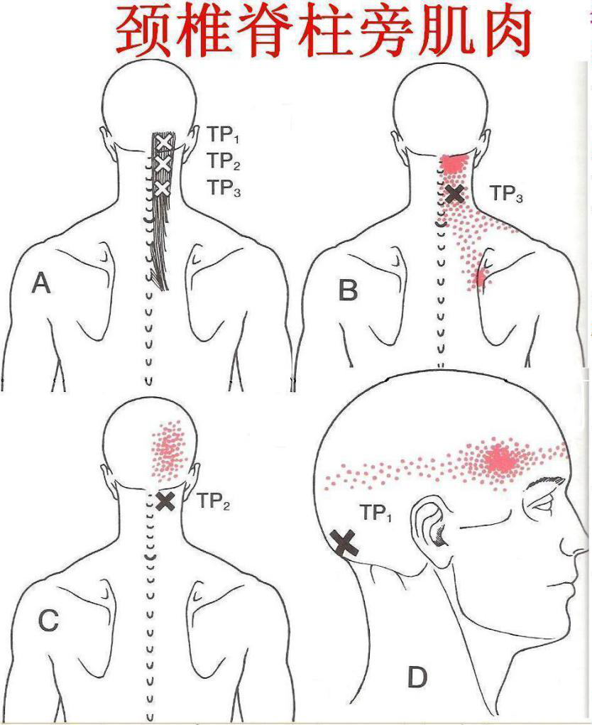 颈肩痛内热针治疗的步骤及布针要点_试验