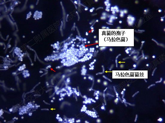 真菌阳性荧光图镜下可见真菌菌丝,假菌丝及出芽孢子