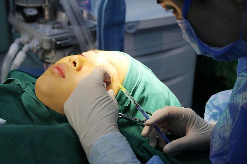 记录莲池双眼皮全切手术全过程即刻效果令人震撼