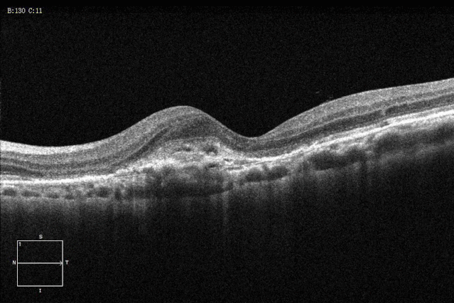 左眼黄斑区亦见黄白色渗出,无明显出血或新生血管