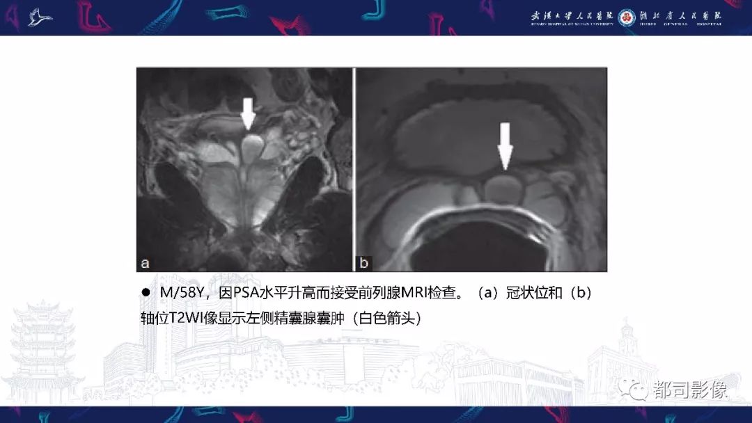 精囊腺病变mri表现