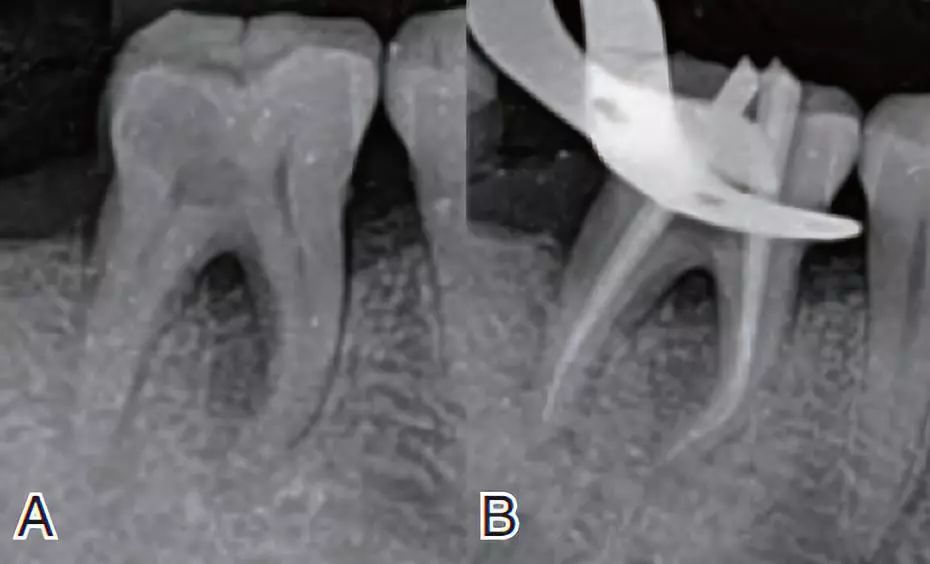 侧支根管的充填经验分享丨年轻医生临床分享会