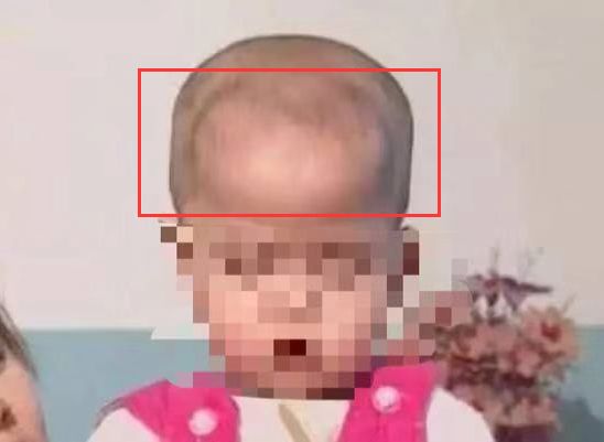 宝宝缺钙方颅照片图片