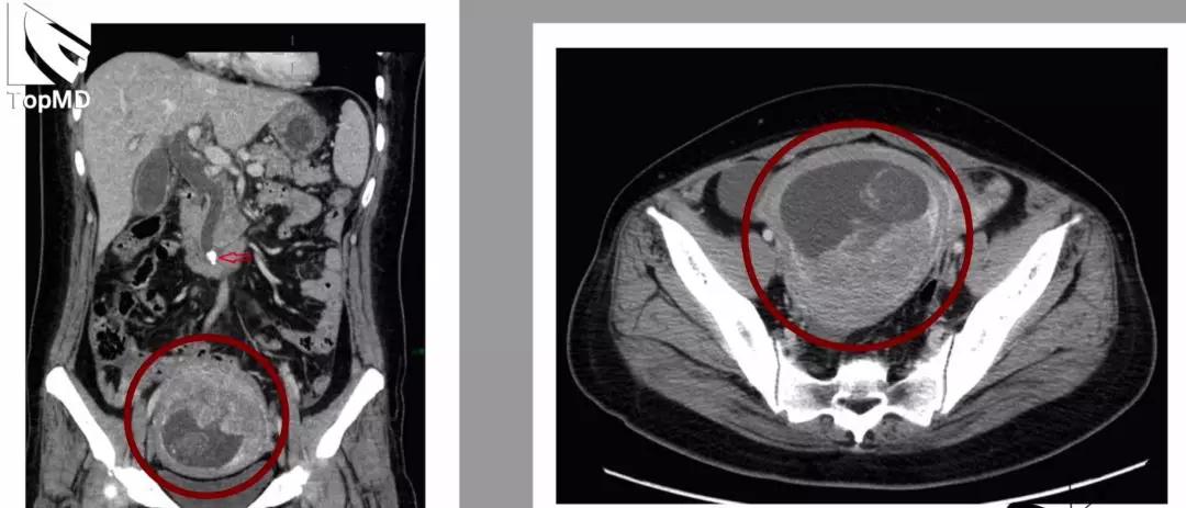 原创怀孕13周因胆总管结石做了ct孩子还能留吗