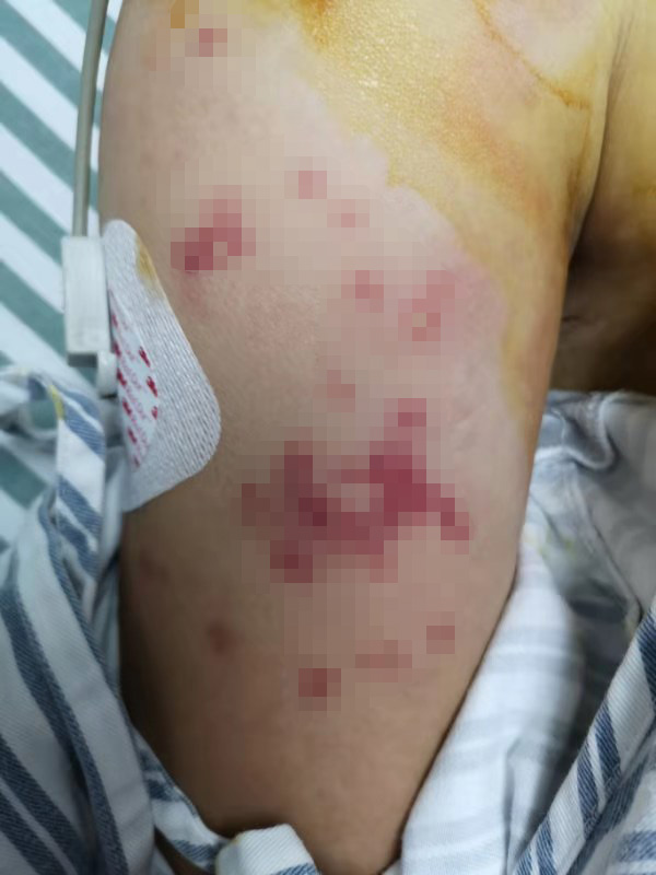 打山核桃捅到巨型马蜂窝杭州夫妻被蜇近百口未脱离生命危险