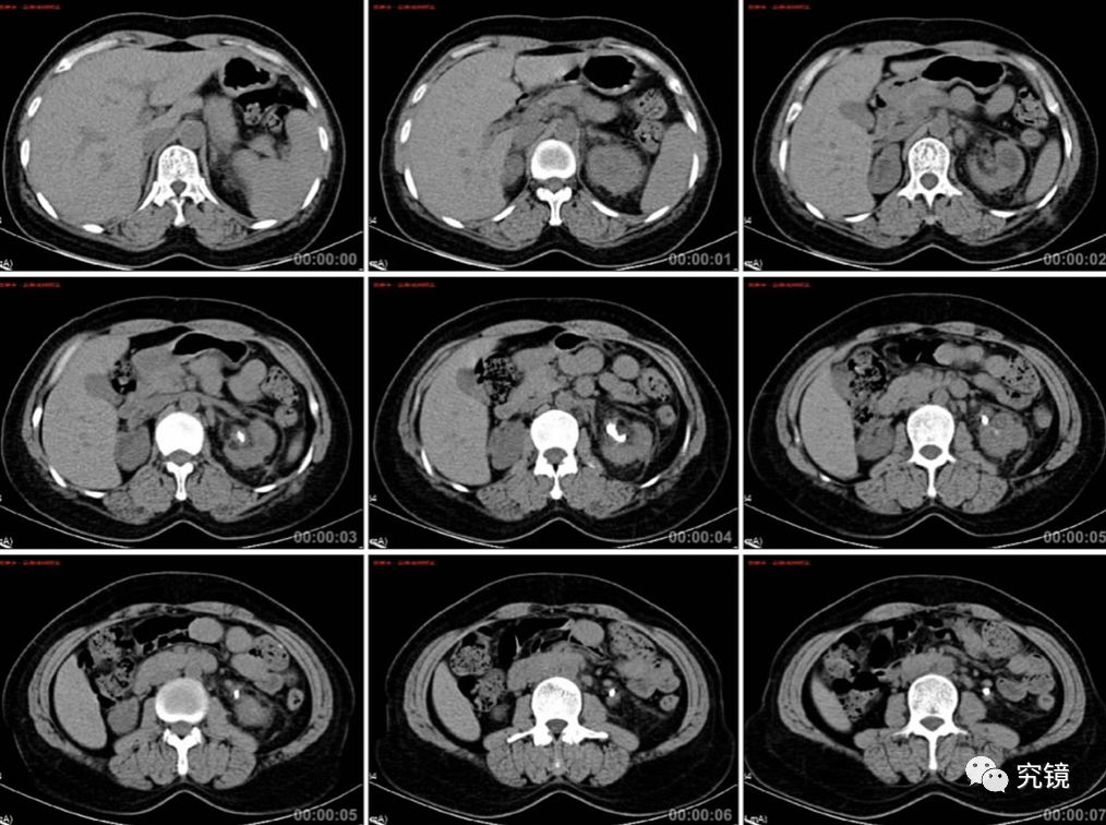 15号作品局麻经皮肾镜处理脓肾合并脓栓1例报道