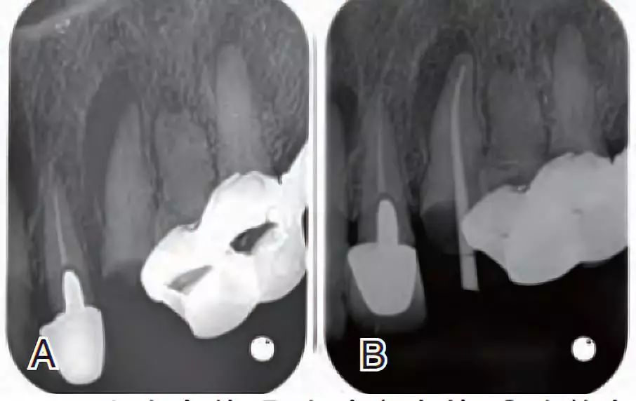 侧支根管的充填经验分享丨年轻医生临床分享会