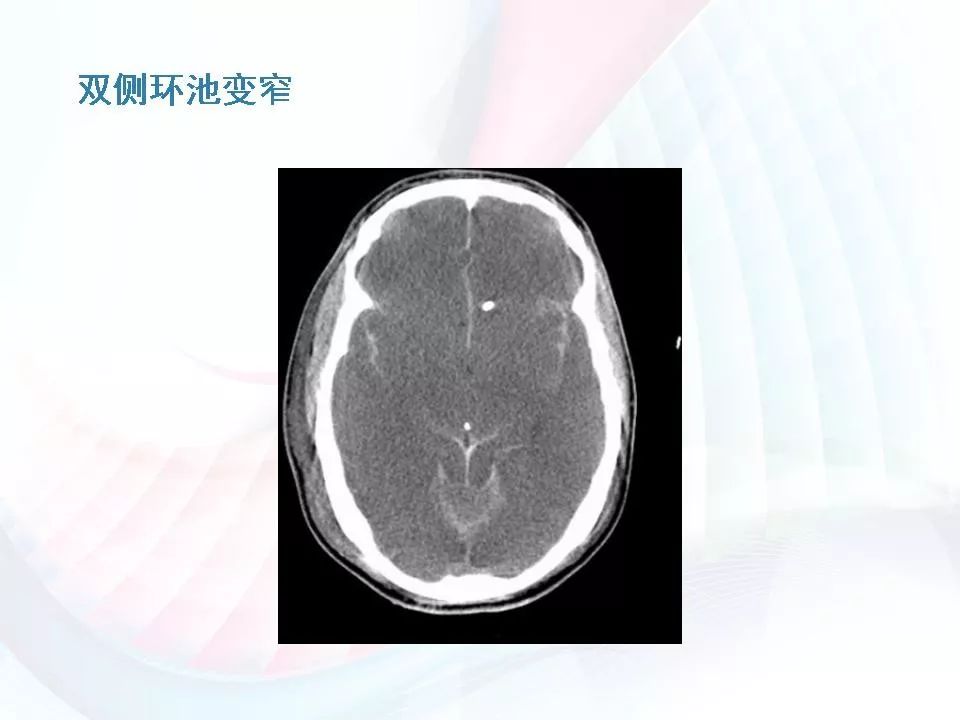 腦疝分類及影像學表現圖解丨影像天地