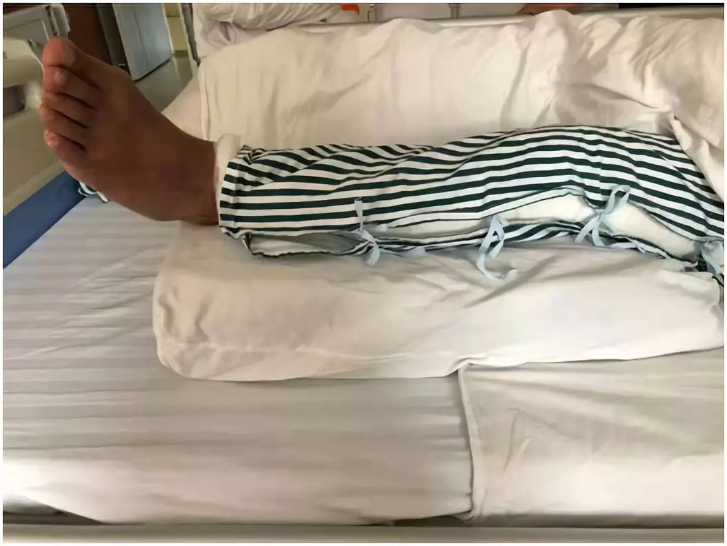 教书育人20余年的她双腿竟长出了数条蚯蚓