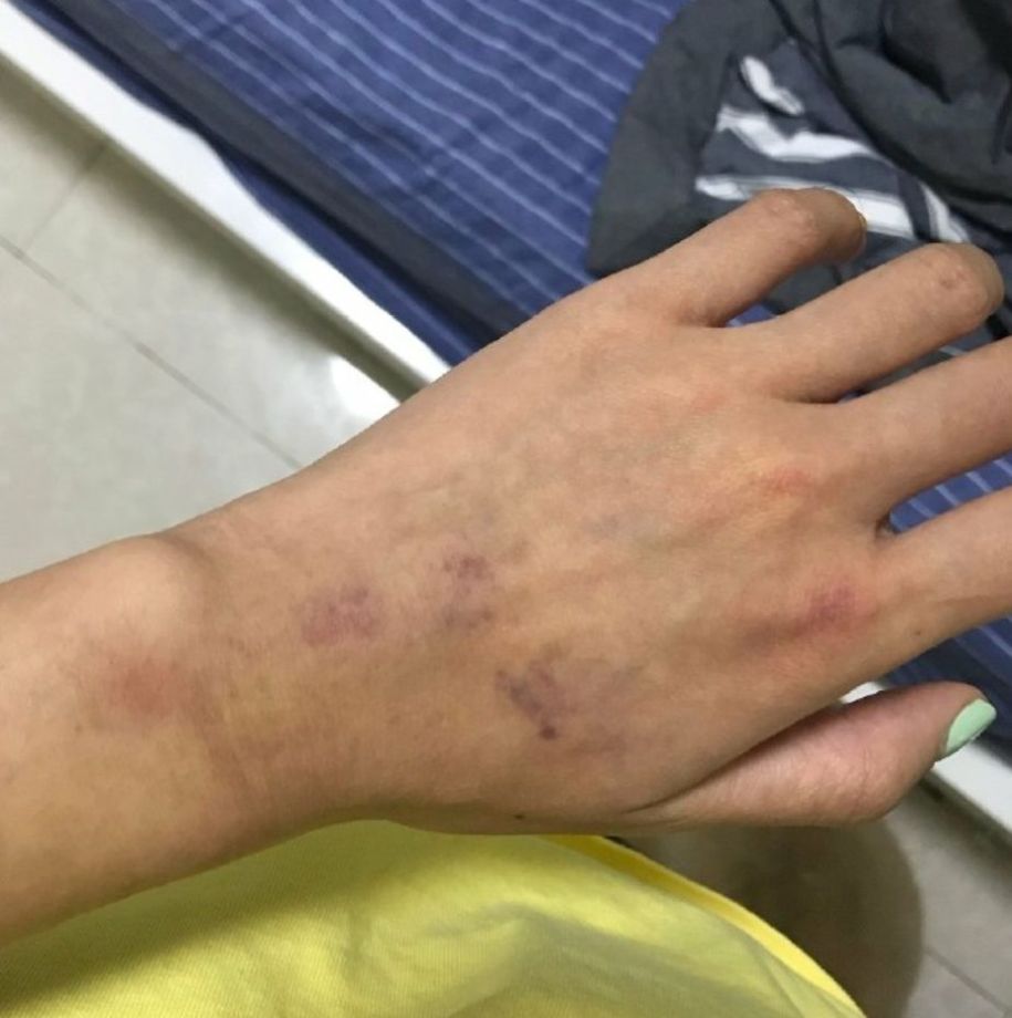 剃头发掰断手指强迫发生关系受伤照片太吓人这男是禽兽啊