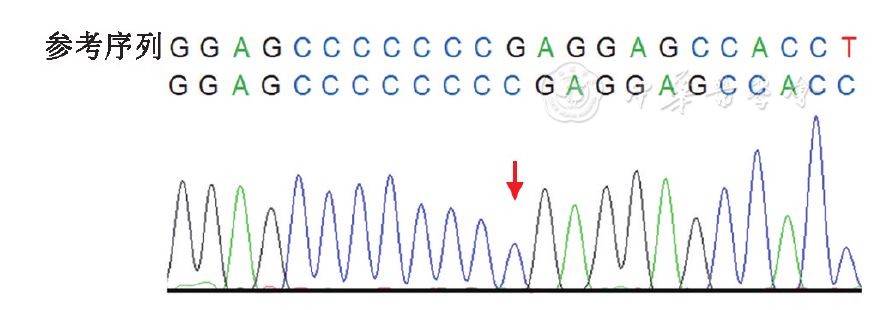 病例报告ikbkg基因移码突变致外胚层发育不良伴免疫缺陷一例