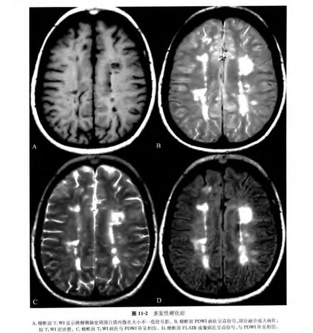 多发性硬化的康复治疗