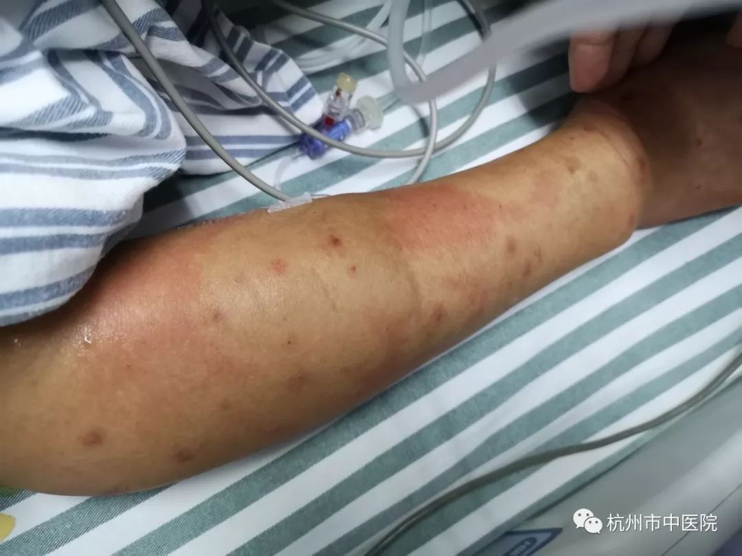 媒体报道临安一对夫妻上山采摘山核桃被ta咬伤险些丧命