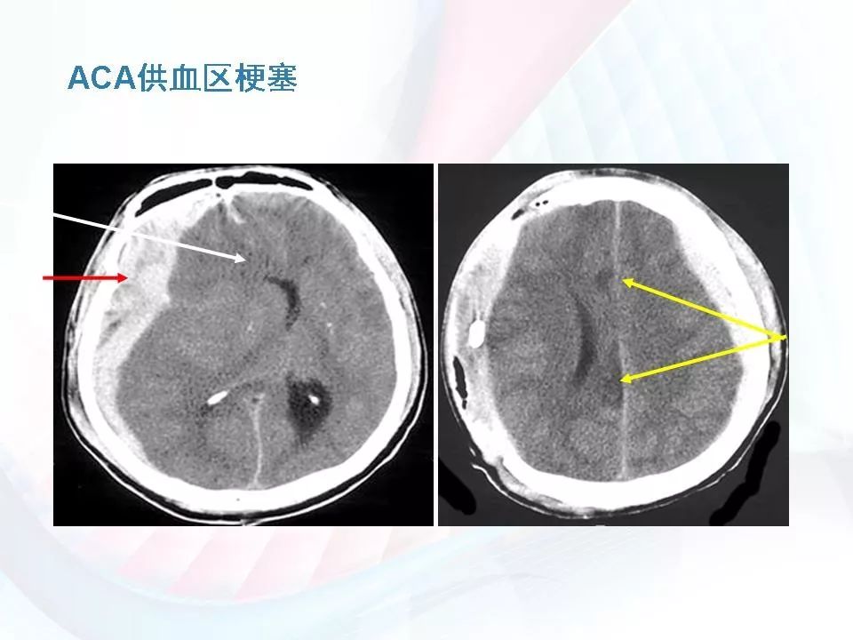 脑疝ct图片的解读图片