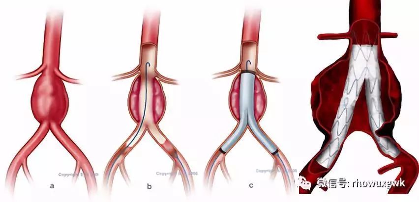 邓宏平教授指出,evar术式在治疗腹主动脉瘤上,有着不可替代的优势,但
