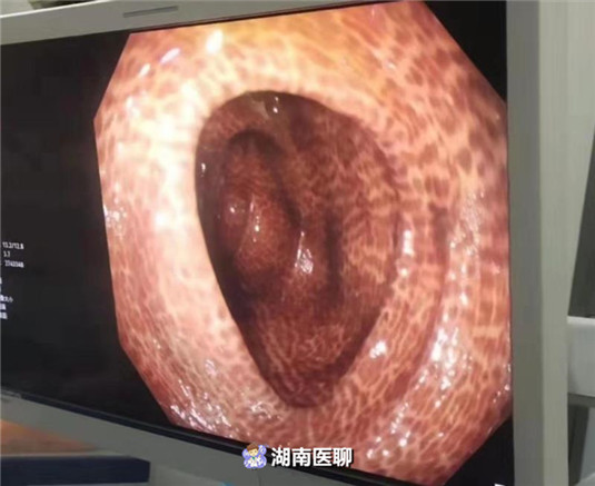 大妈用芦荟治便秘却让肠子穿上了豹纹衣便秘怎么治