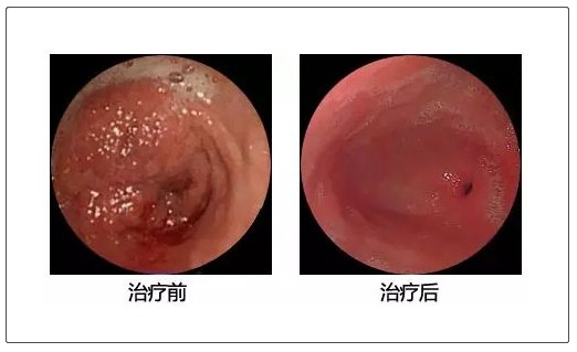 糜烂性胃炎:中医温中和胃,通阳逐水治法