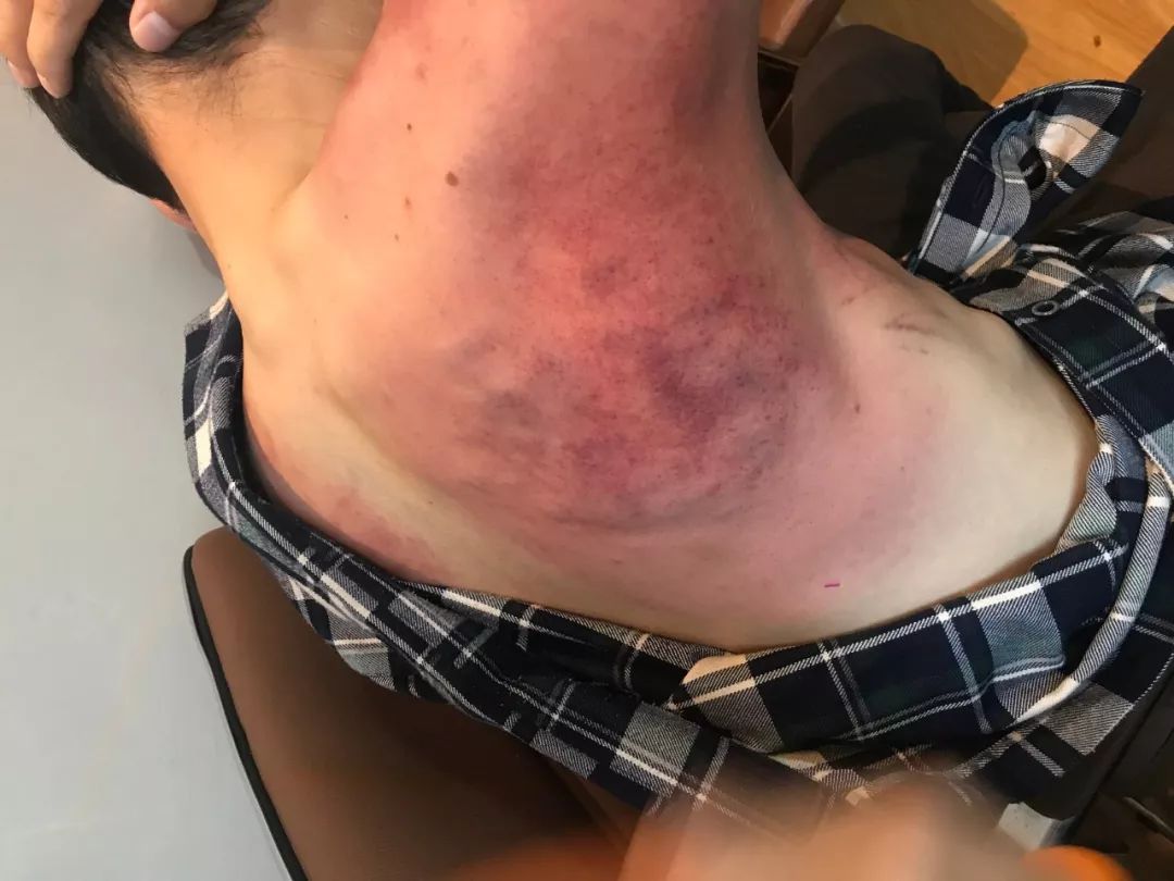 正确拍打两肋即可美容又能排毒