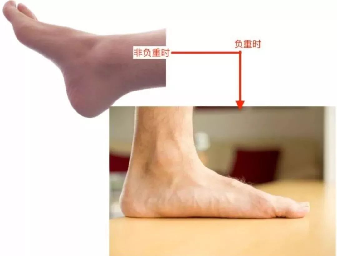 这里还有两种普遍情况:一是足弓即使在不负重时也不存在;二是负重时会