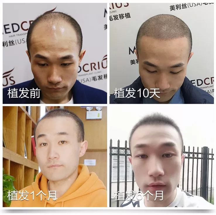 面对脱发不再慌张：科学治疗助你重拾自信