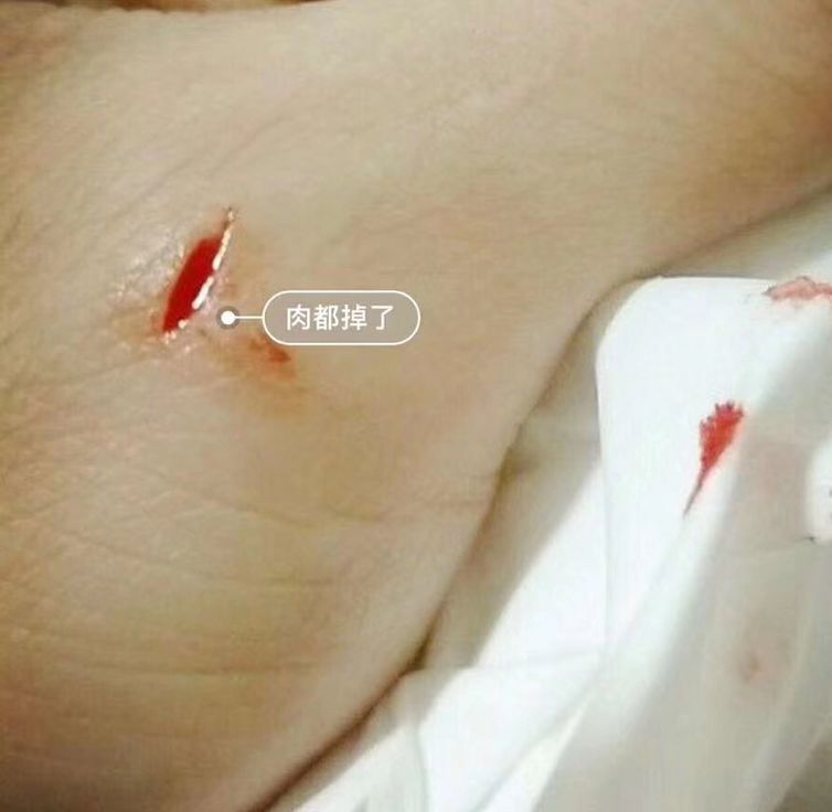 伤口只需一喷一抹就能好而且不留疤防水透气洗澡都不怕