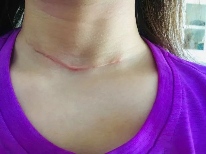 年纪轻轻 得癌是怎样的体验_手术