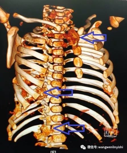 (右側胸壁的腫瘤部位)(右側胸壁及左側胸壁的腫瘤部位)(右側胸壁的