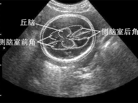 胎儿侧脑室增宽,宝宝一定是畸形儿吗?