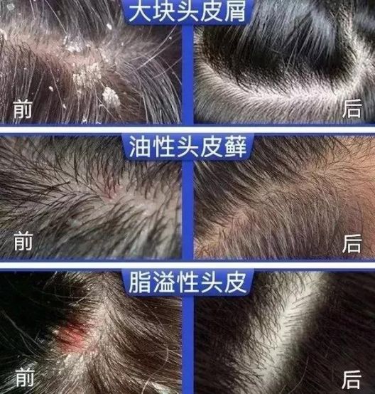 头皮总痒还爱出油?试试中国寄生虫病预防控制所研发的洗发水