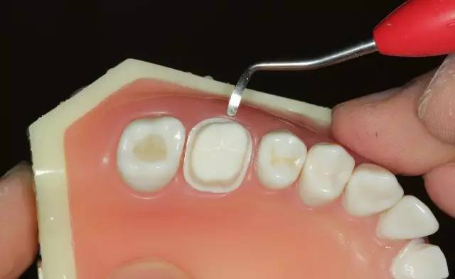硅橡胶导板牙体预备步骤详解