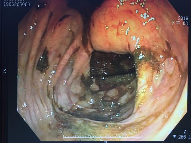 肠镜大便水样标准图片图片