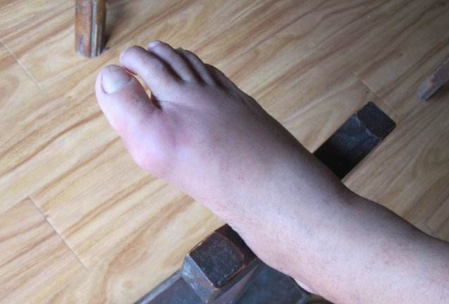 尿酸高就一定会患痛风吗不这样控制可避免痛风