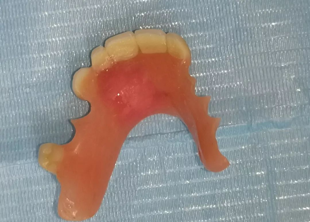 男篮世界杯球员义齿断裂,我院口腔科30分钟修复获赞!_牙齿