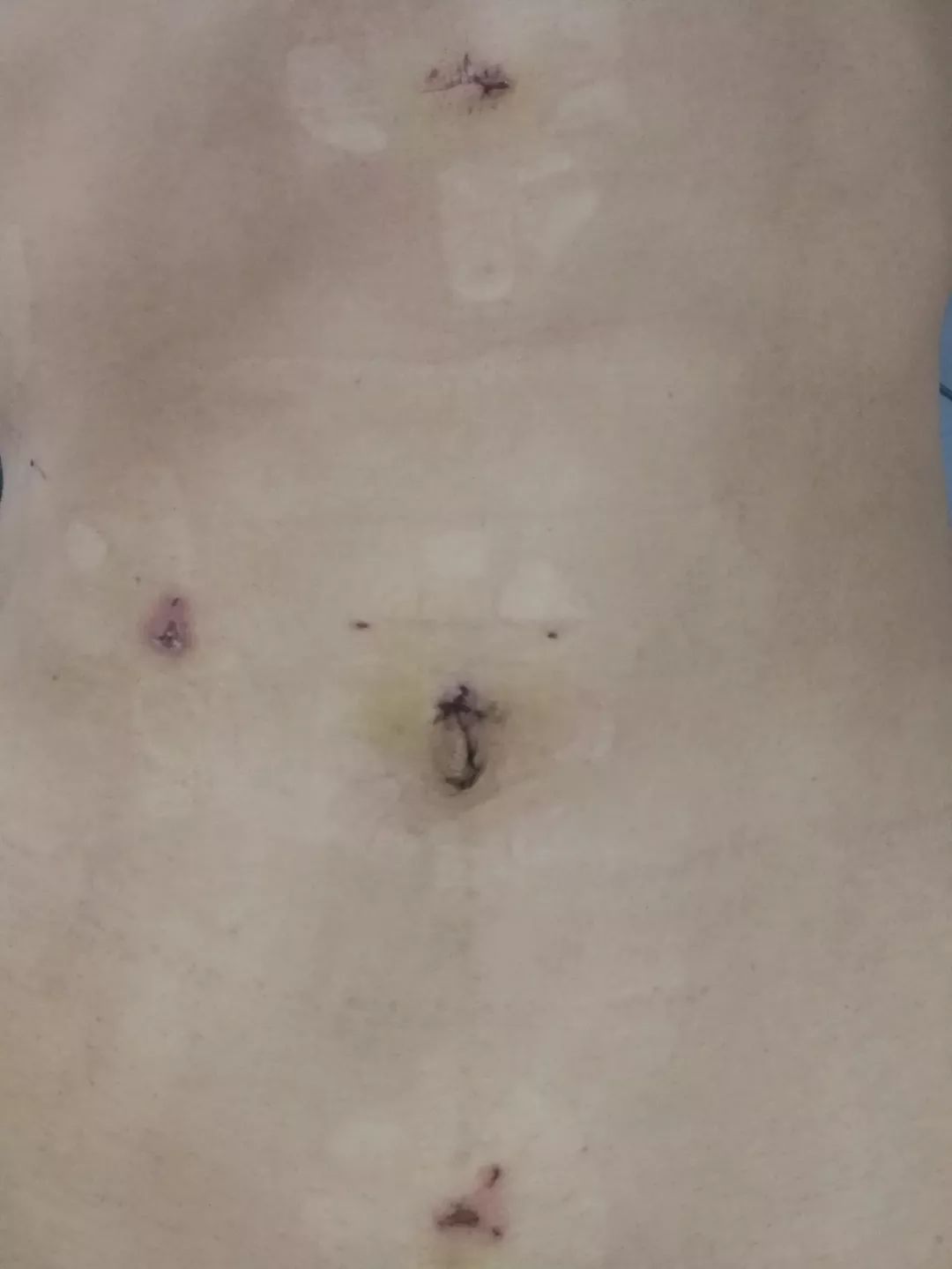 我院普外科成功开展一例腹腔镜下胃穿孔修补术